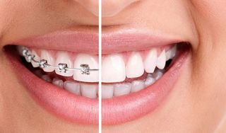 123 Braces NMB