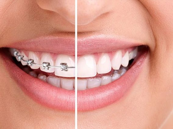 123 Braces NMB photo